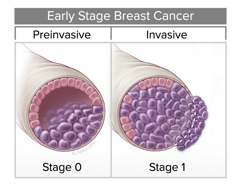 Earty Stage Breast Cancer diagram